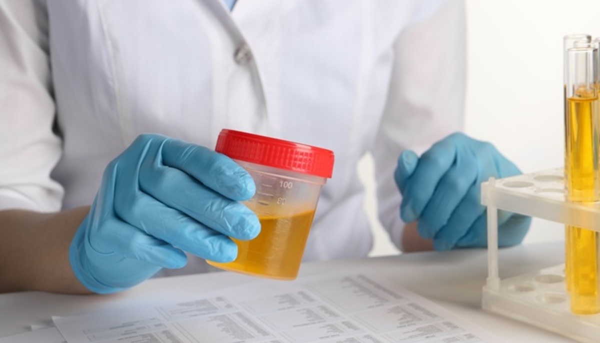 Scientists Develop Simple Urine Test That Accurately Detects Prostate Cancer