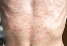 Rising Measles Cases in South Carolina Threaten U.S. Elimination Status